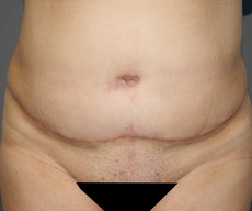 Abdominoplasty - Pacient, abdominoplasty - After 1 month