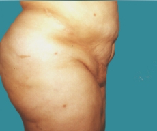 Abdominoplasty - 48 years old patient, abdominoplasty - After 12 months