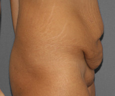 Abdominoplasty - Pacient, abdominoplasty - After 1 year