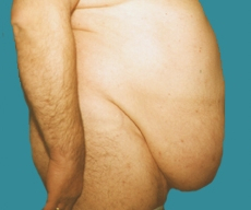 Abdominoplasty - 53 years old patient, abdominoplasty - After 6 months