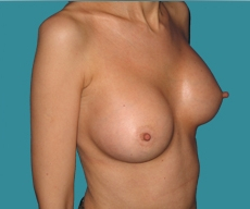 Breast enlargement - 39 years old patient, Matrix implants 295 cm3 left breast, 280 right breast - After 10 months