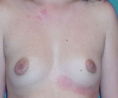 Breast enlargement - Breast enlargement with Matrix 360 implants - After 