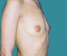 Breast enlargement - Breast enlargement with Matrix 320 implants - After 