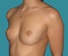 Breast enlargement - 27 years old patient, Matrix implants 320 cm3 left breast, 335 right breast - After 1 month
