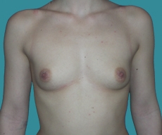 Breast enlargement - 20 years old patient, implants Matrix 295 cm3, submuscular position, inframammary approach - After 1 month