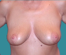 Breast lift - Breast lift - After 