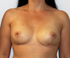 Prophylactic mastectomy - Pacienta 40 de ani cu istoric personal de mastoza fibrochistica bilateral. Mastectomie subcutanata profilactica pe incizii de mamopexie si reconstructie imediata cu proteze mamare Mentor rotunde 300 CC subpectoral. - After 1 month