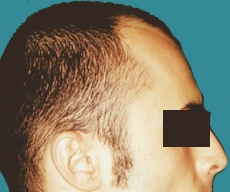 Hair transplant - Hair transplant, result after 2 sessions - After 3 months after the second transplant