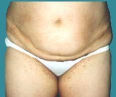 Liposuction - 37 years old patient, liposuction abdomen - After 1 month