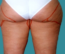 Liposuction - 31 years old patient, liposuction inner and outer thighs - After 8 months