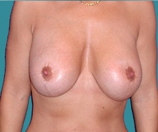 Breast lift with implants - Breast lift with Mentor 315 implants positioned under the pectoral muscle - After 