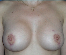 Breast lift with implants - Breast lift with Mentor 280 implants - After 3 months
