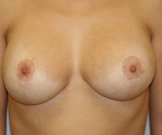 Breast lift with implants - Pacienta de 43 de ani, mamopexie cu proteze Mentor rotunde 250cc, subpectoral - After 1 year