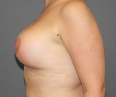 Breast lift with implants - Pacienta de 36 de ani, mamopexie cu proteze Mentor rotunde 275cc sanul stang, 300cc sanul drept, subpectoral - After 3 months