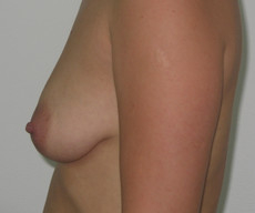 Breast lift with implants - Pacienta de 27 de ani, mamopexie cu proteze Mentor rotunde 300cc, subpectoral - After 1 month