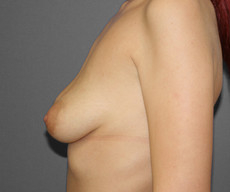 Breast lift with implants - Pacienta de 23 de ani, mamopexie cu proteze Mentor rotunde 345 g - After 1 month