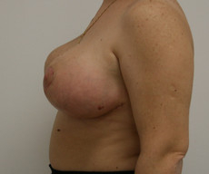 Breast reduction - Pacienta, gigantomastie - After 1 month