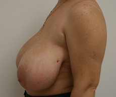 Breast reduction - Pacienta, gigantomastie - After 1 month