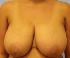 Breast reduction - Pacienta, gigantomastie - After 3 months