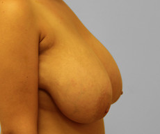 Breast reduction - Pacienta, gigantomastie - After 3 months