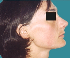 Rhinoplasty - 23 years old patient, rhinoplasty - After 3 months
