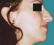 Rhinoplasty - 25 years old patient, rhinoplasty - After 6 months