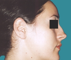 Rhinoplasty - 24 years old patient, rhinoplasty - After 3 months
